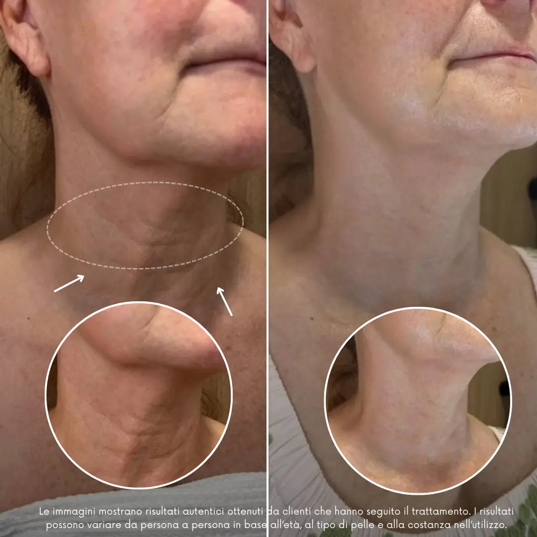 BioLyn | Sistema di Microinfusione Avanzata