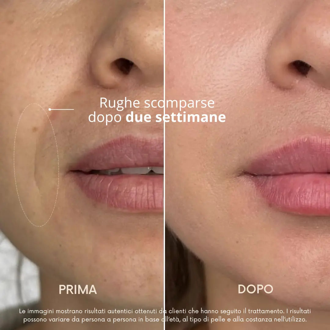 BioLyn | Sistema di Microinfusione Avanzata