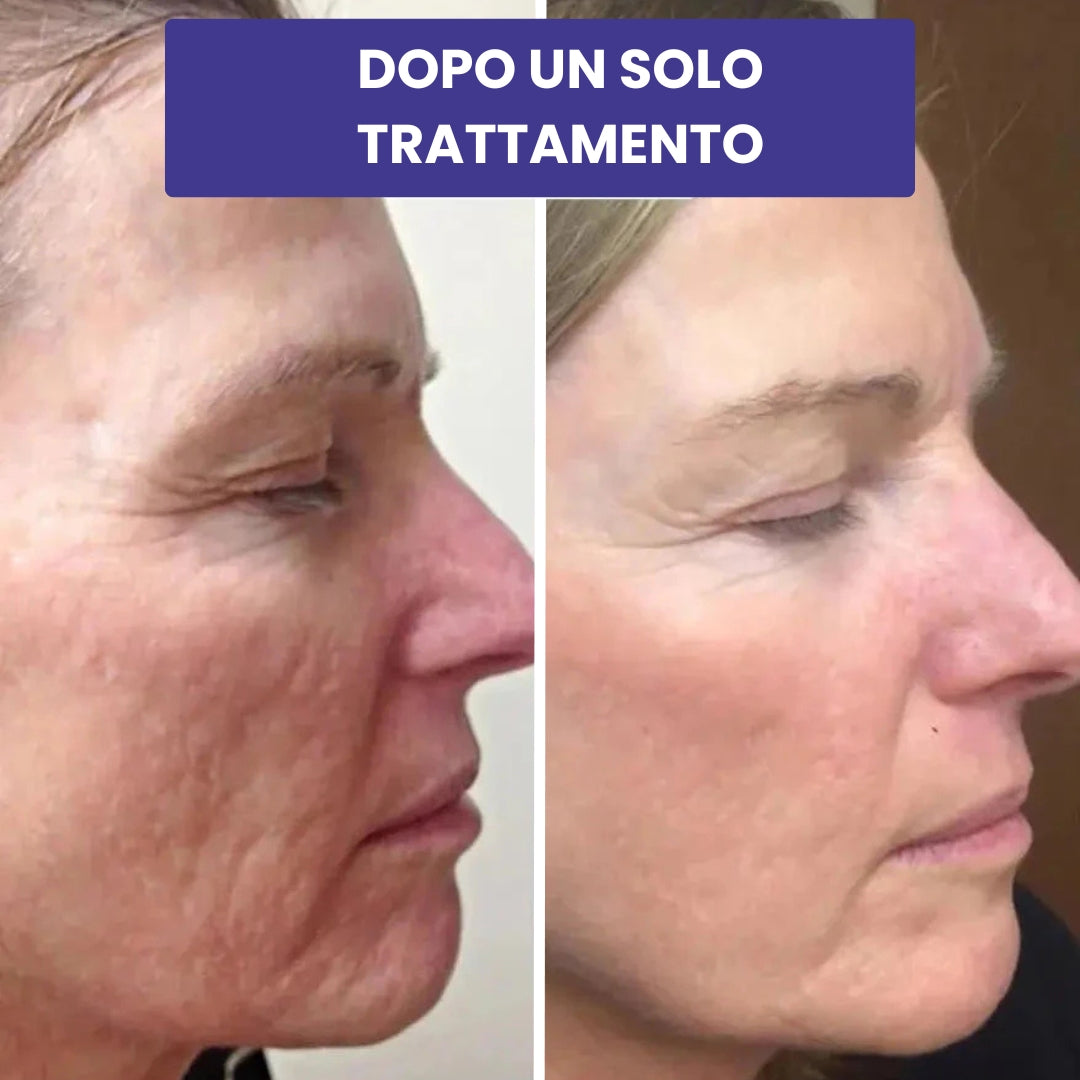 BioLyn+ | Sistema di Microinfusione Avanzata