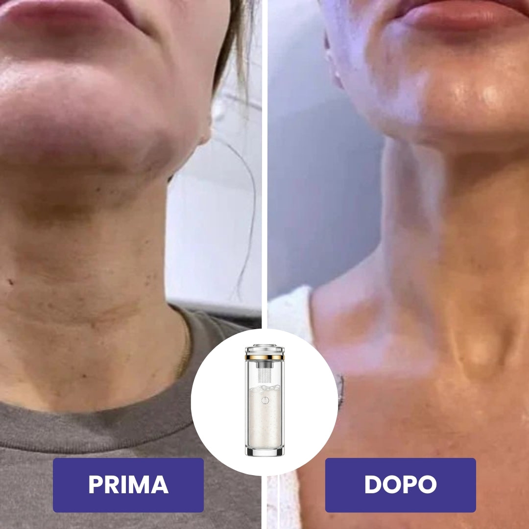 BioLyn+ | Sistema di Microinfusione Avanzata