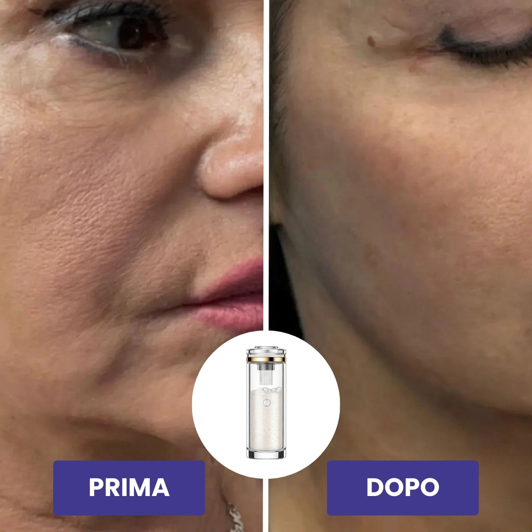 BioLyn+ | Sistema di Microinfusione Avanzata