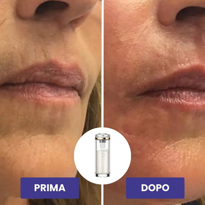 BioLyn+ | Sistema di Microinfusione Avanzata
